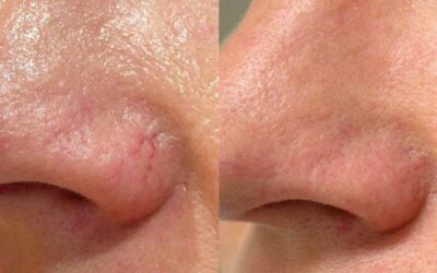 Tratamiento de las Telangiectasias con Láser IPL