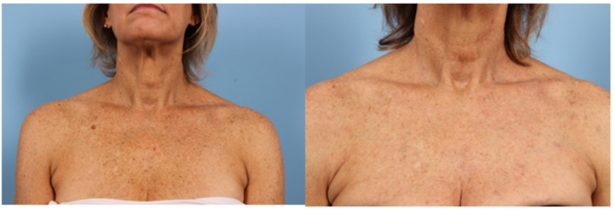 Tratamiento de fotorejuvenecimiento facial